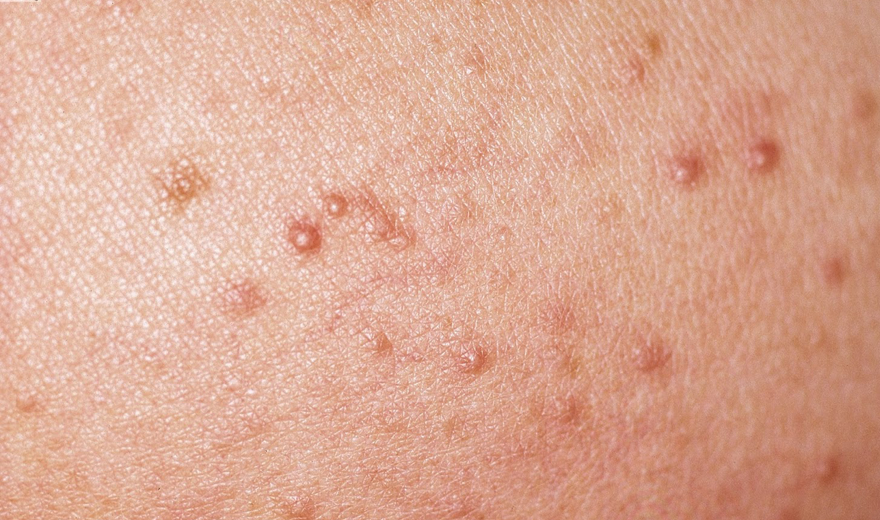 blog zonne allergie mallorca acne content bij het huidinstituut 